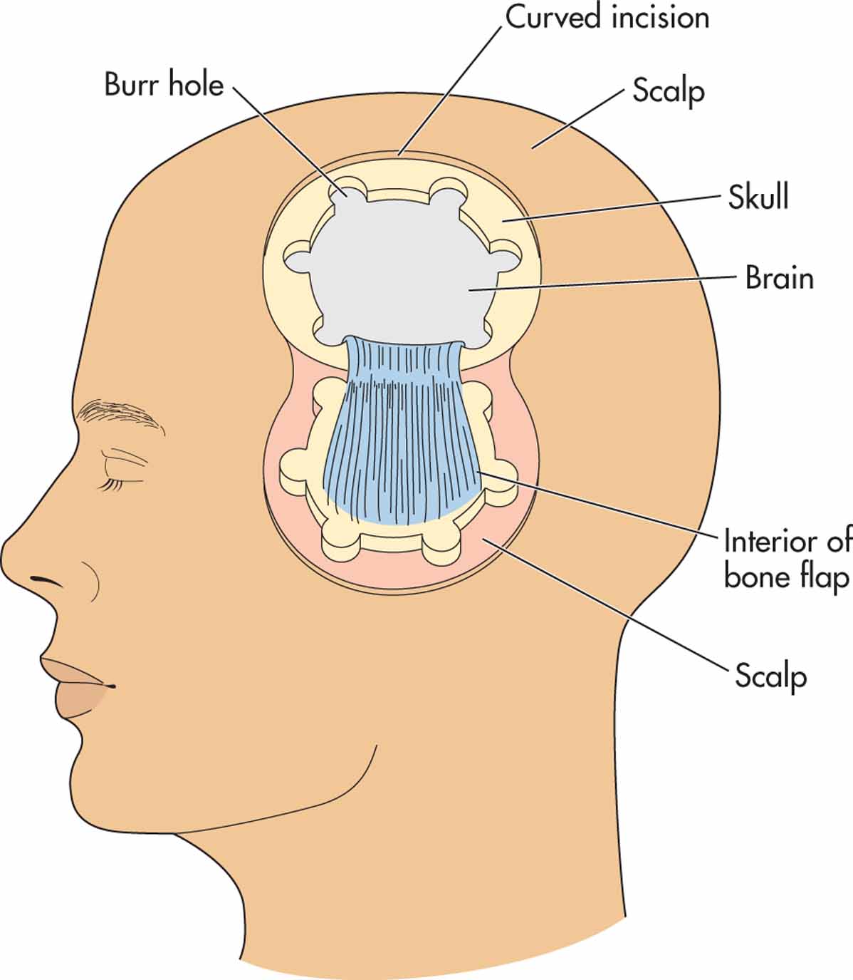 In a craniotomy, a portion of the skull and overlying scalp is pulled back to allow access to the br