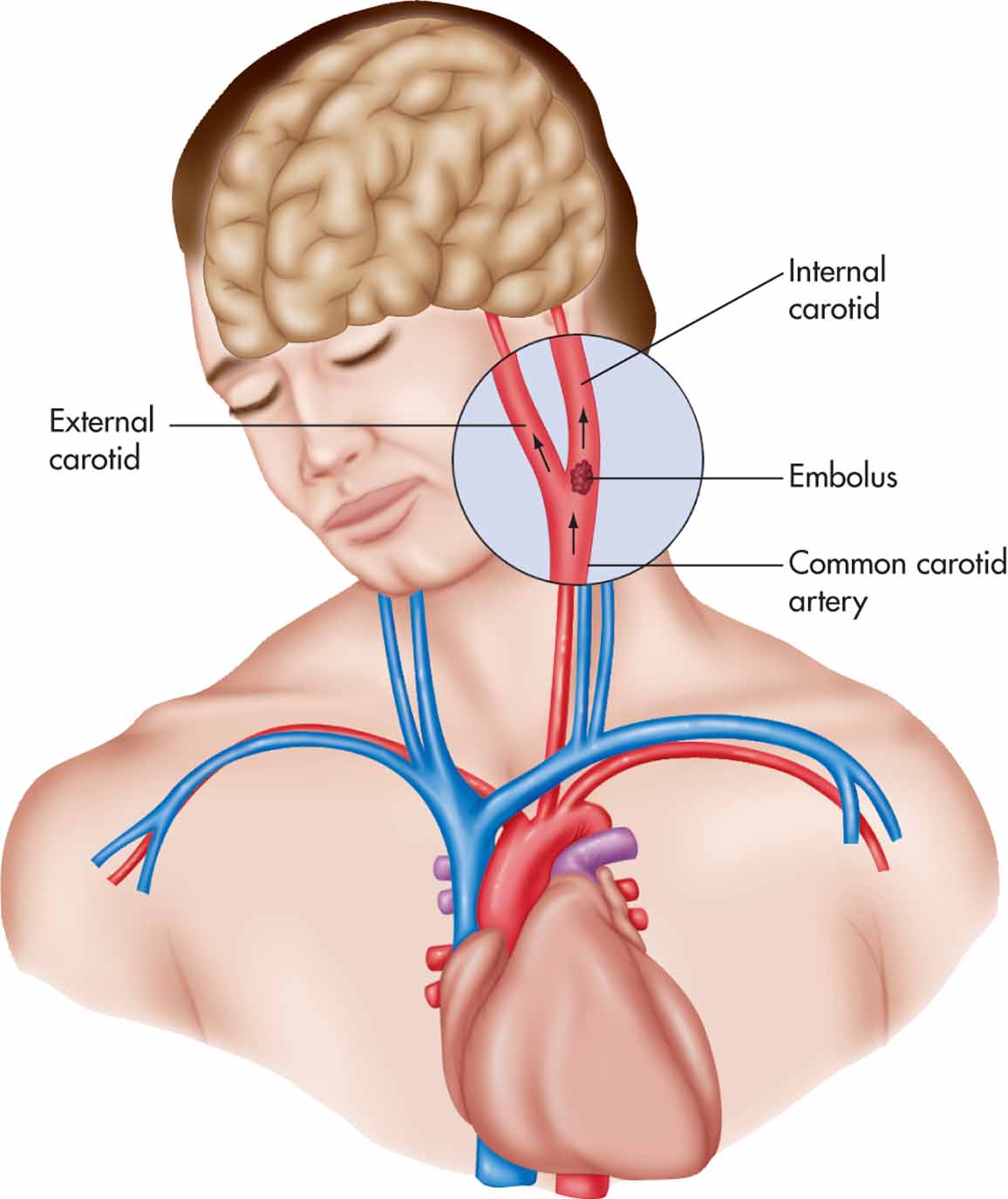 Embolus traveling to the brain.