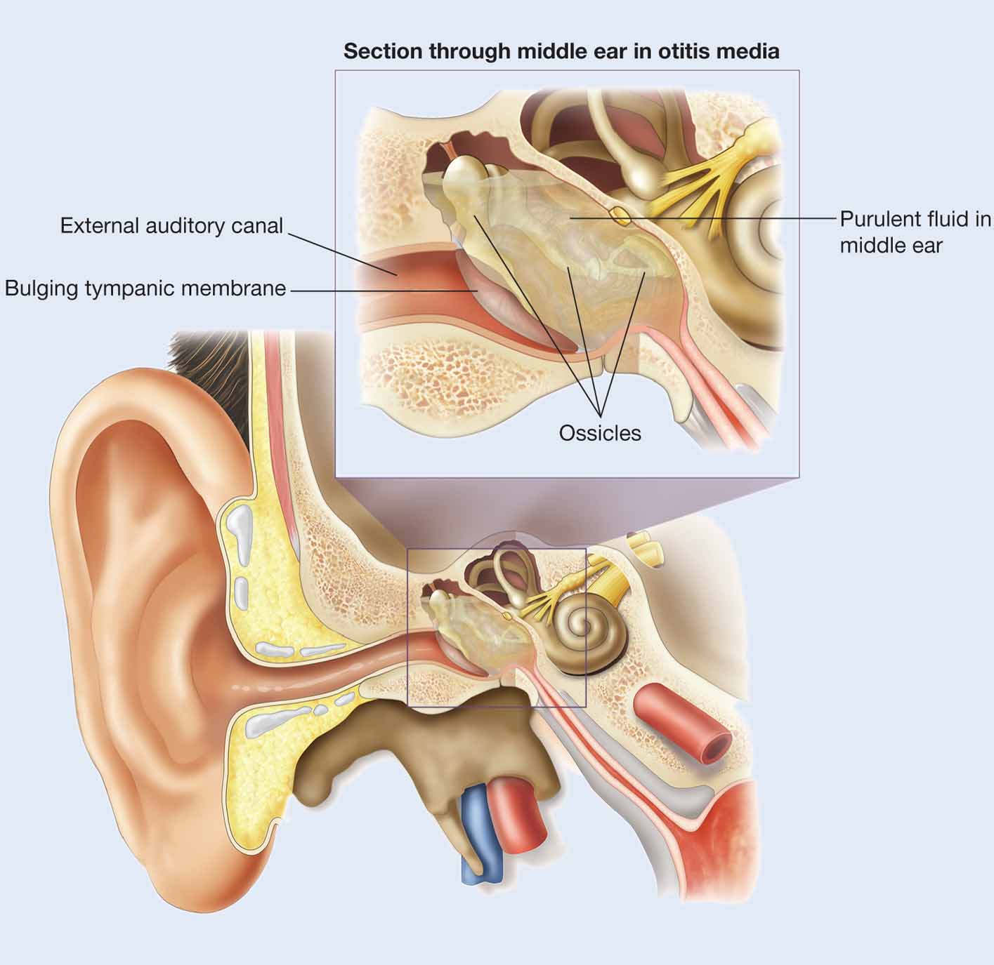 In acute otitis media, the tympanic membrane is usually bulging and purulent fluid is present in the