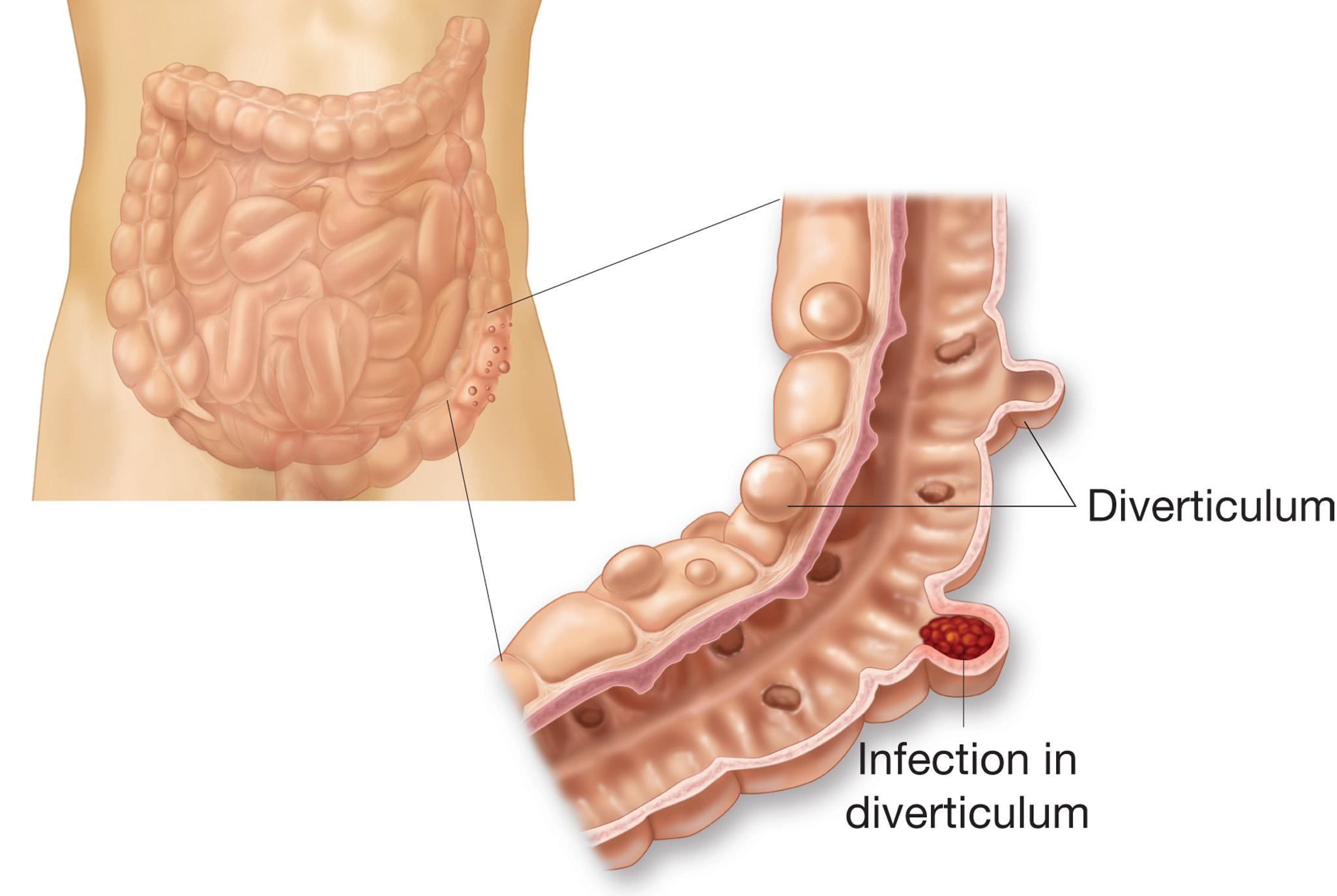 Diverticulosis. Figure illustrates external and internal appearance of diverticula. 