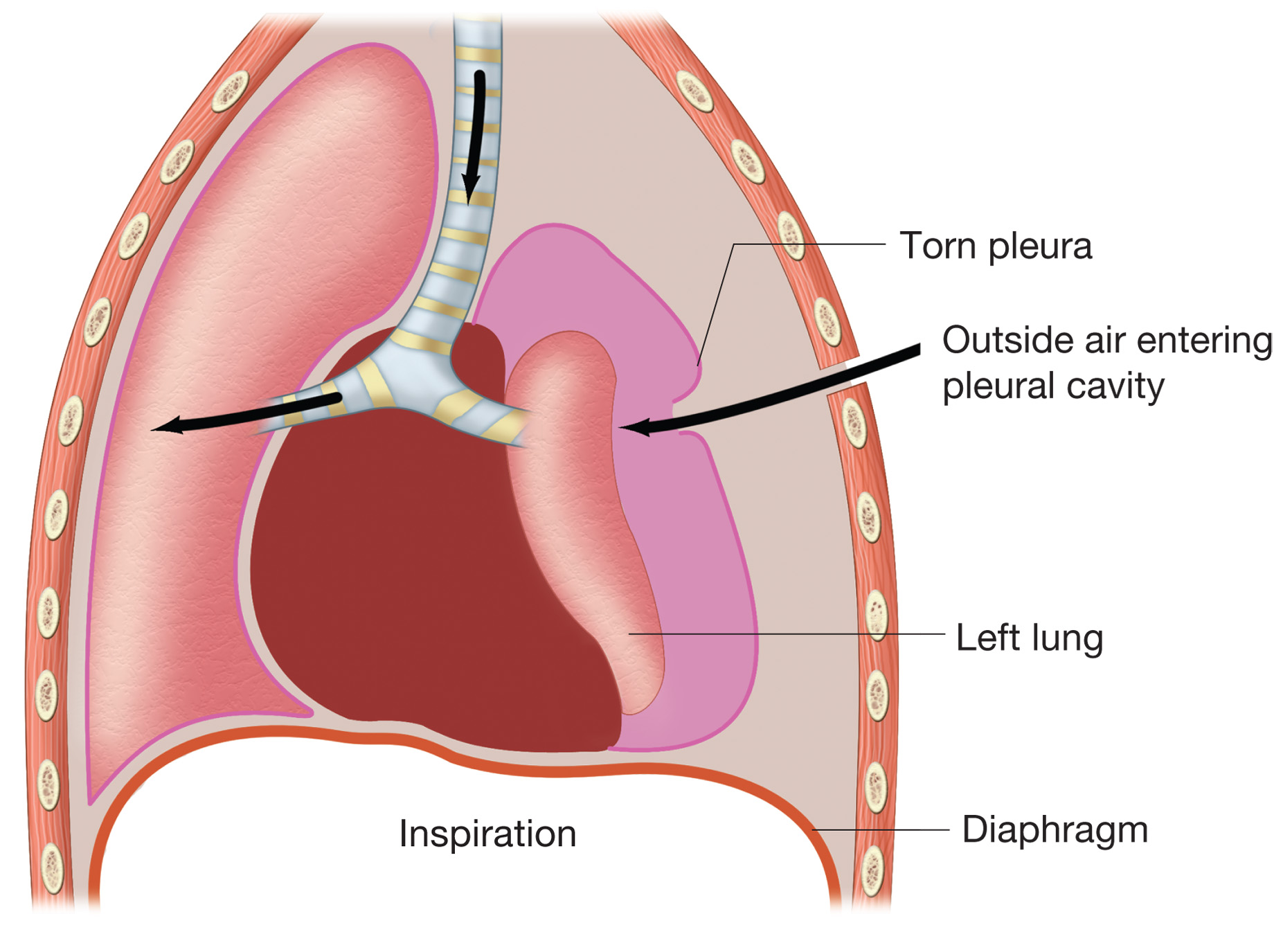 Pneumothorax. Figure illustrates how puncture of thoracic wall and tearing of pleural membrane allow