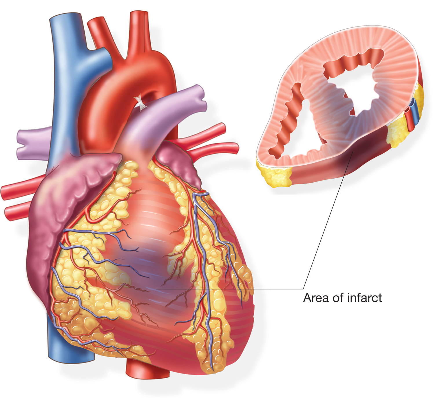 External and cross-sectional view of an infarct caused by a myocardial infarction. 