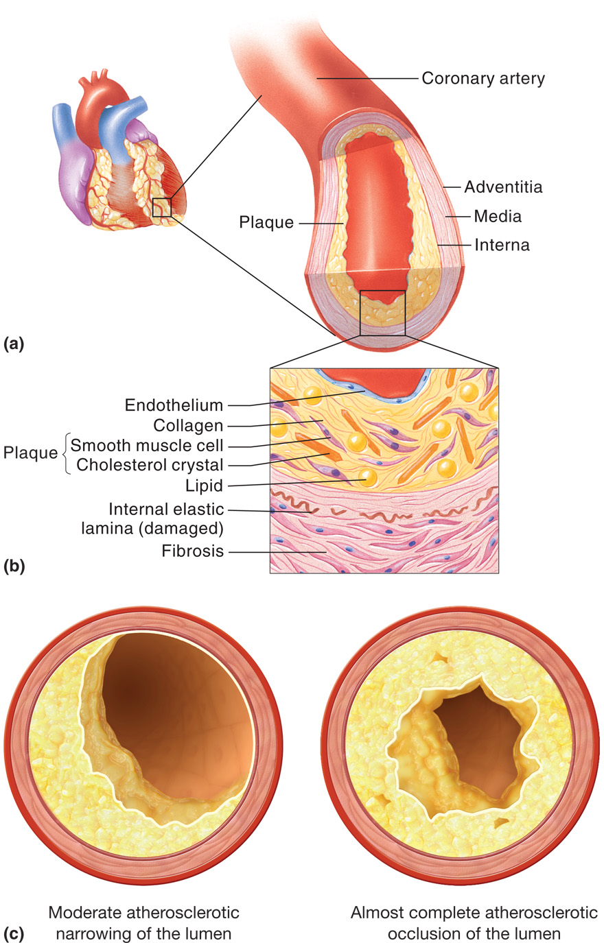 Atherosclerosis. (a) A sectioned coronary artery that exhibits an accumulation of fatty plaque, whic