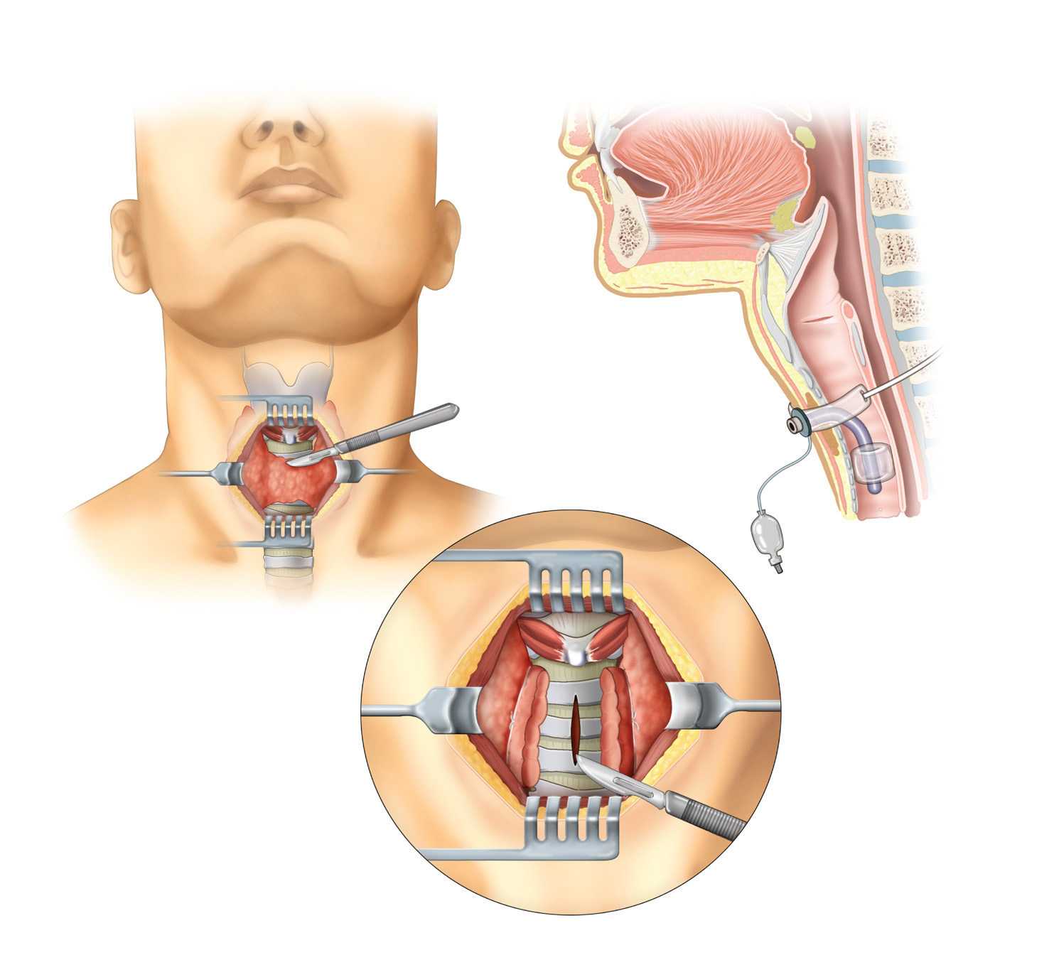 Tracheostomy. A tracheotomy, or incision into the trachea, is performed to create an opening into th