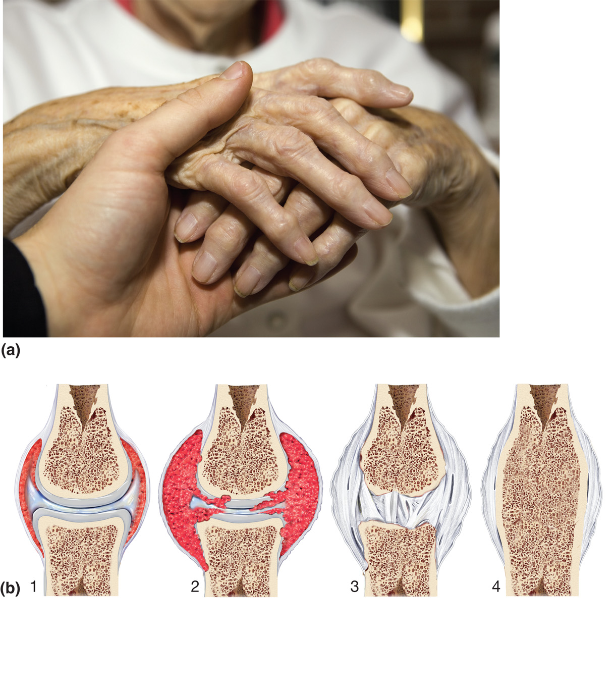 Arthritis. (a) Photograph of osteoarthritis within the joints of the fingers.