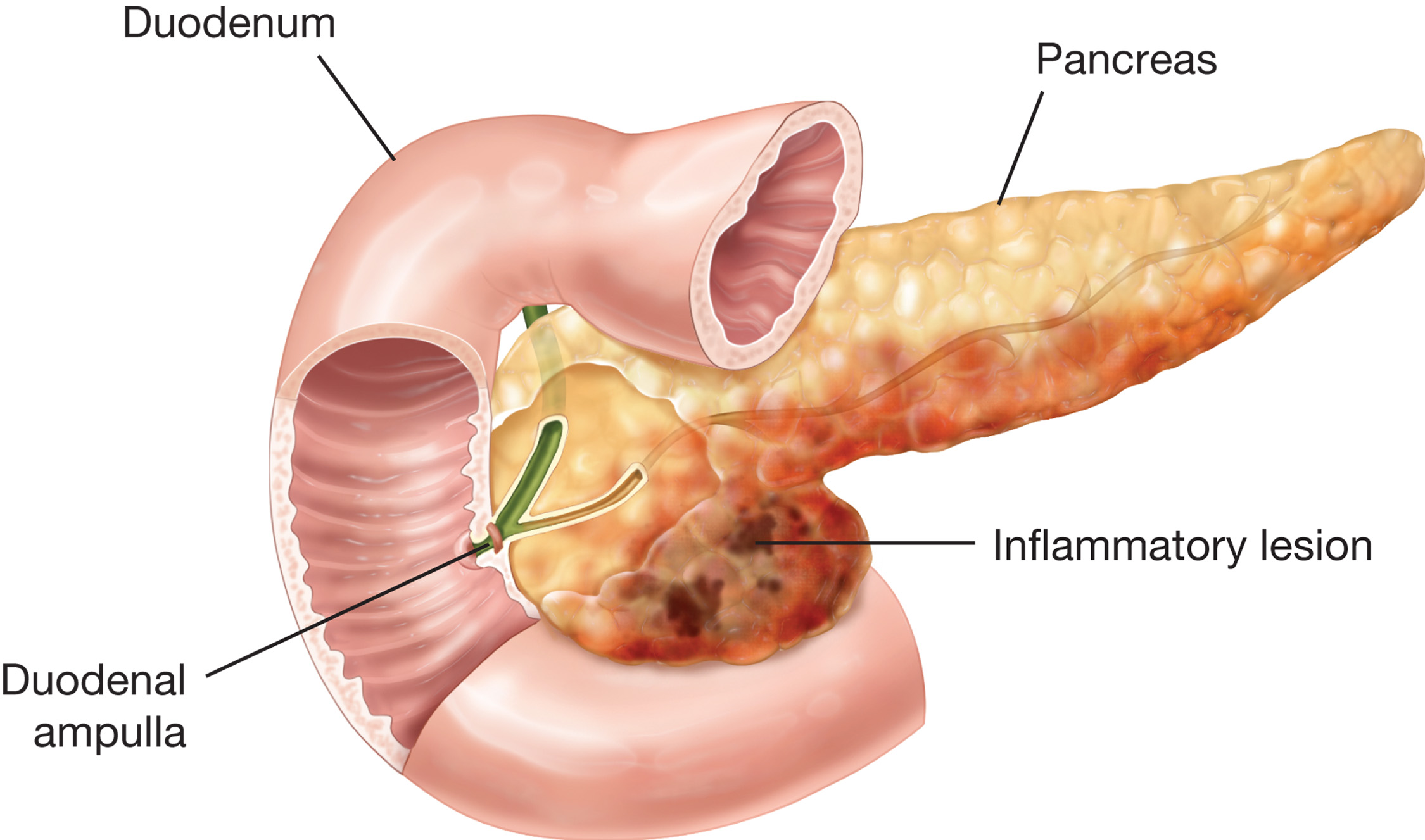 Pancreatitis. Inflammation of the pancreas may be the result of a bacterial infection, trauma, or ch