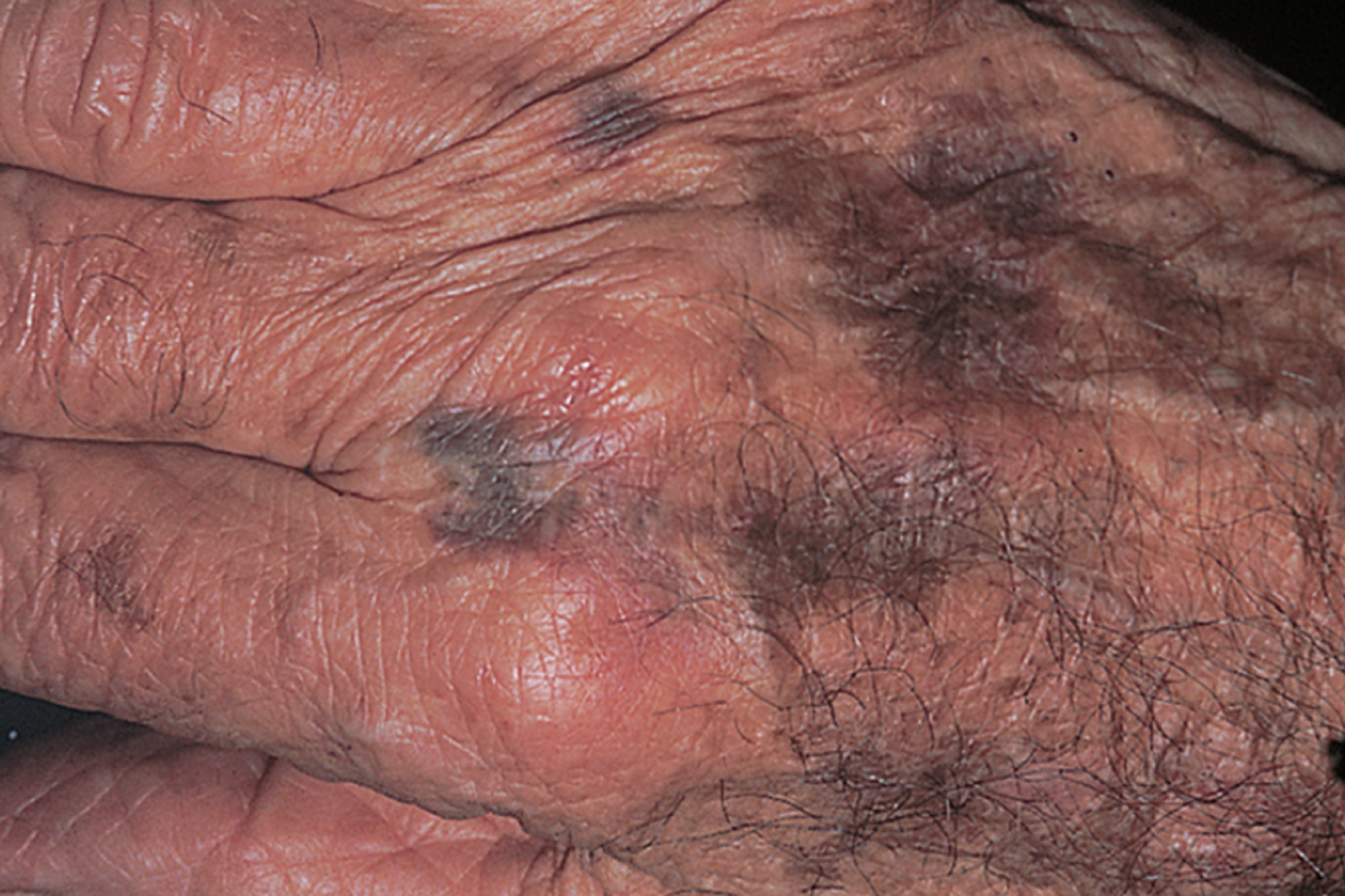 Purpura, hemorrhaging into the skin due to fragile blood vessels. 