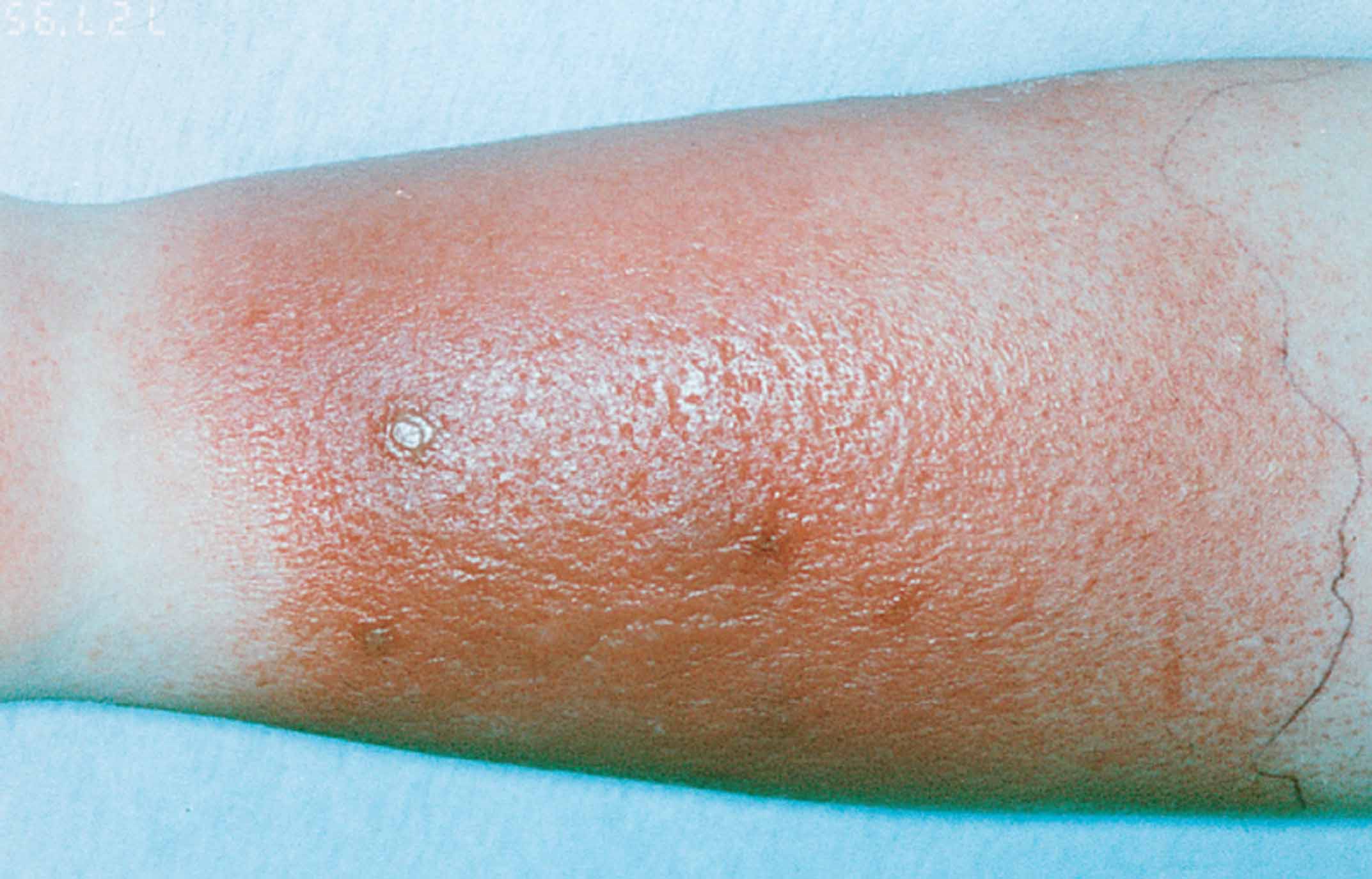 Cellulitis