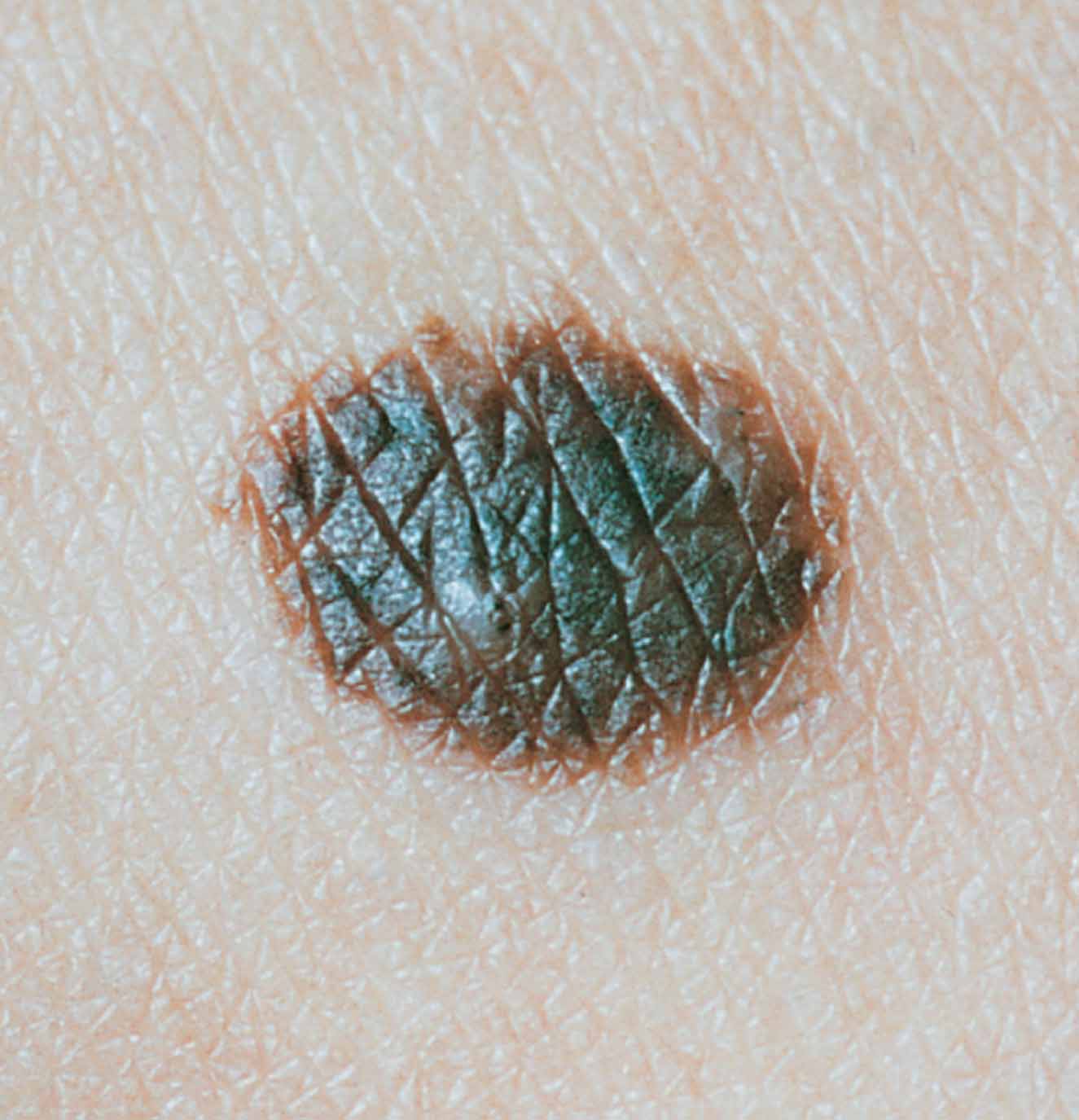 Nevus mole