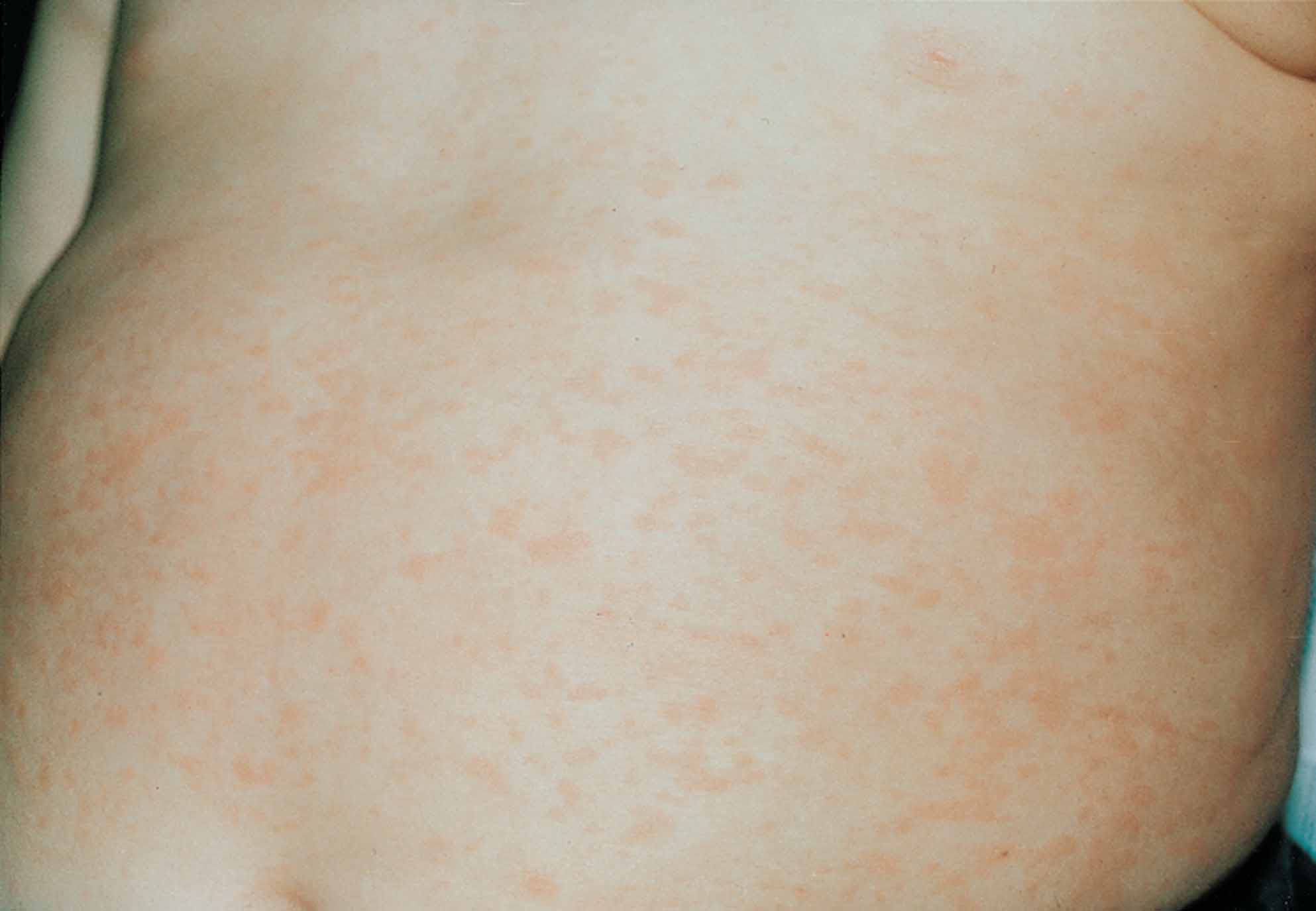 Roseola