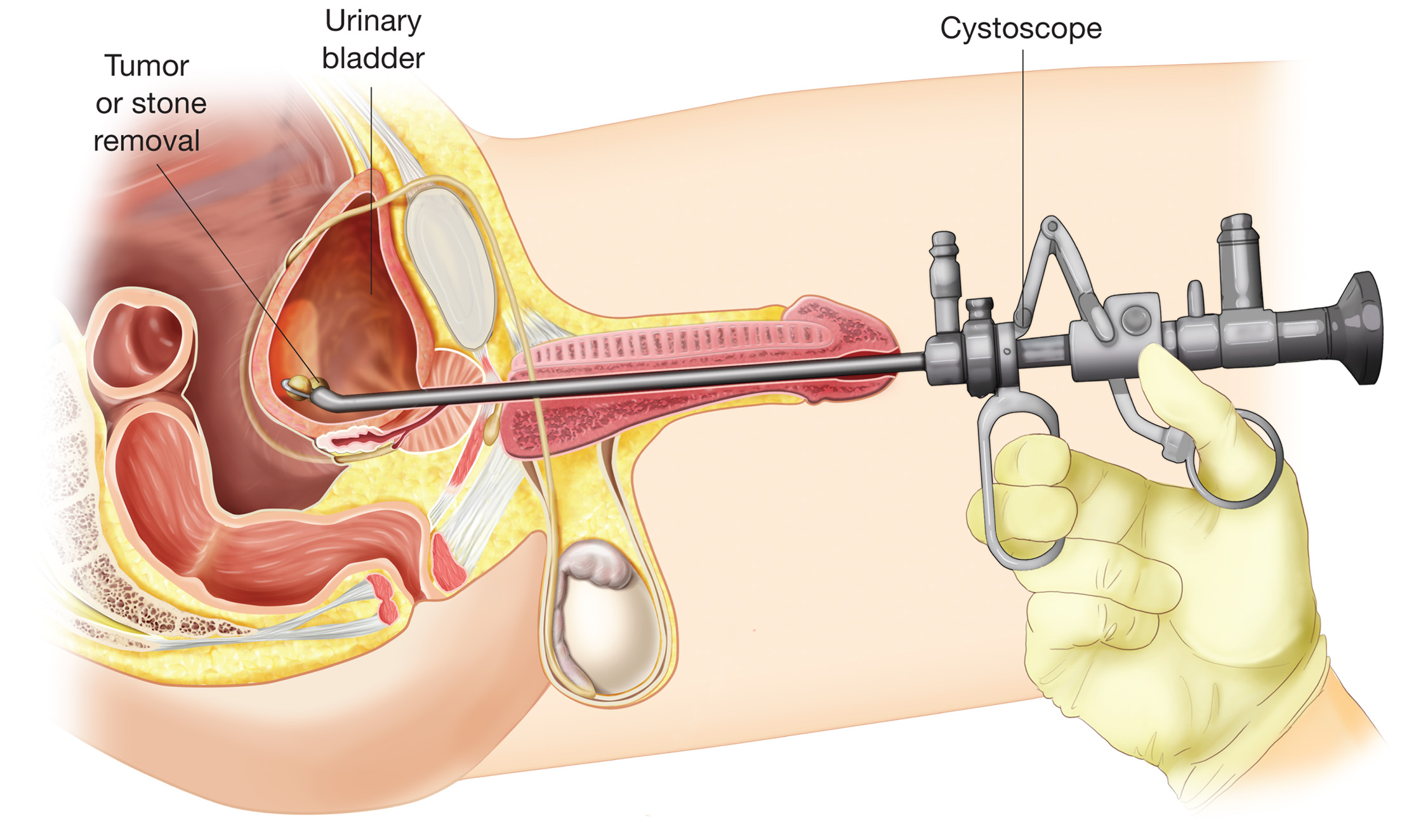 Cystoscopy. In this procedure, a specialized endoscope with a rigid tube, known as a cystoscope, is 