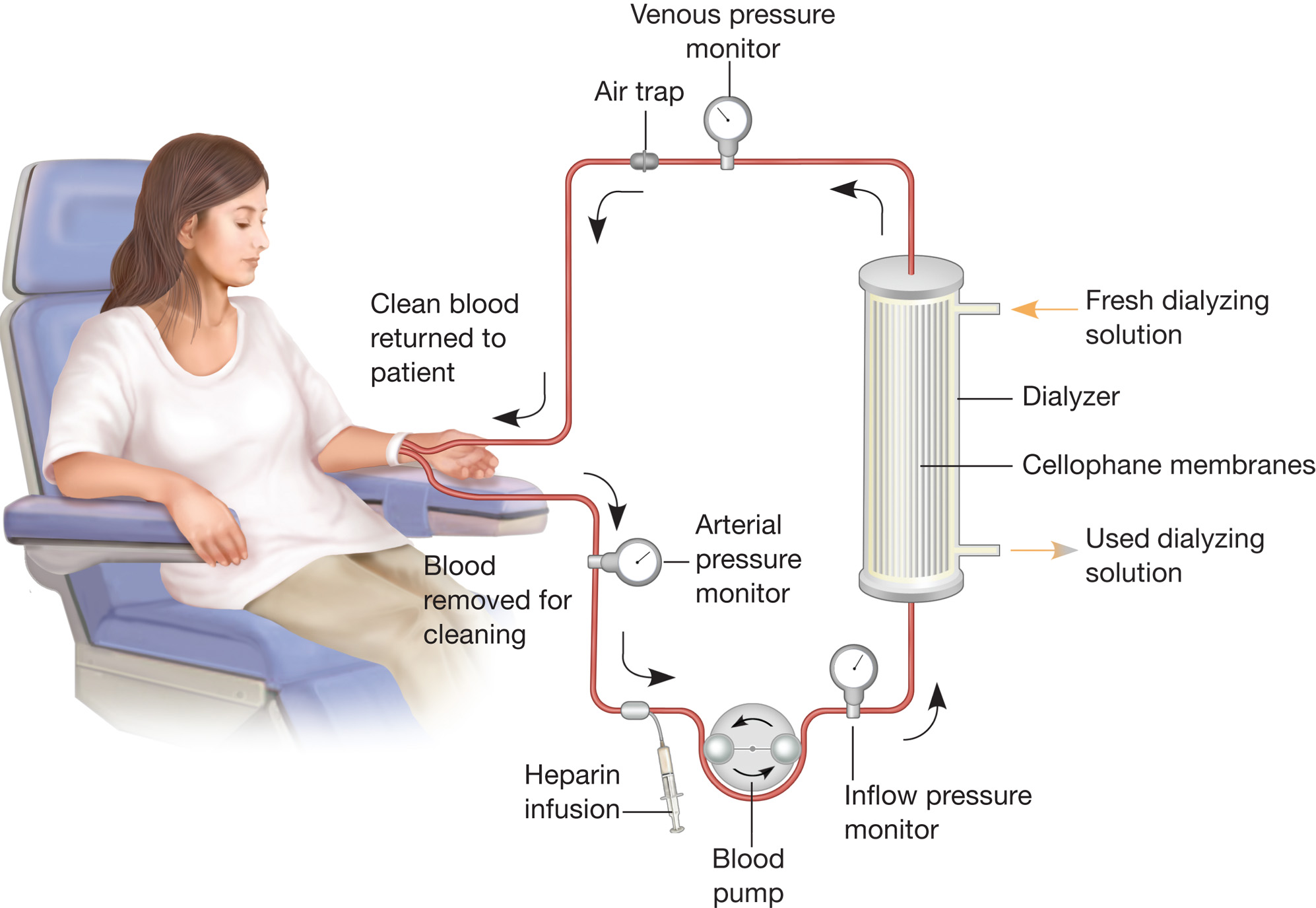 Hemodialysis. The process of hemodialysis replaces the kidney function of blood filtration by forcin