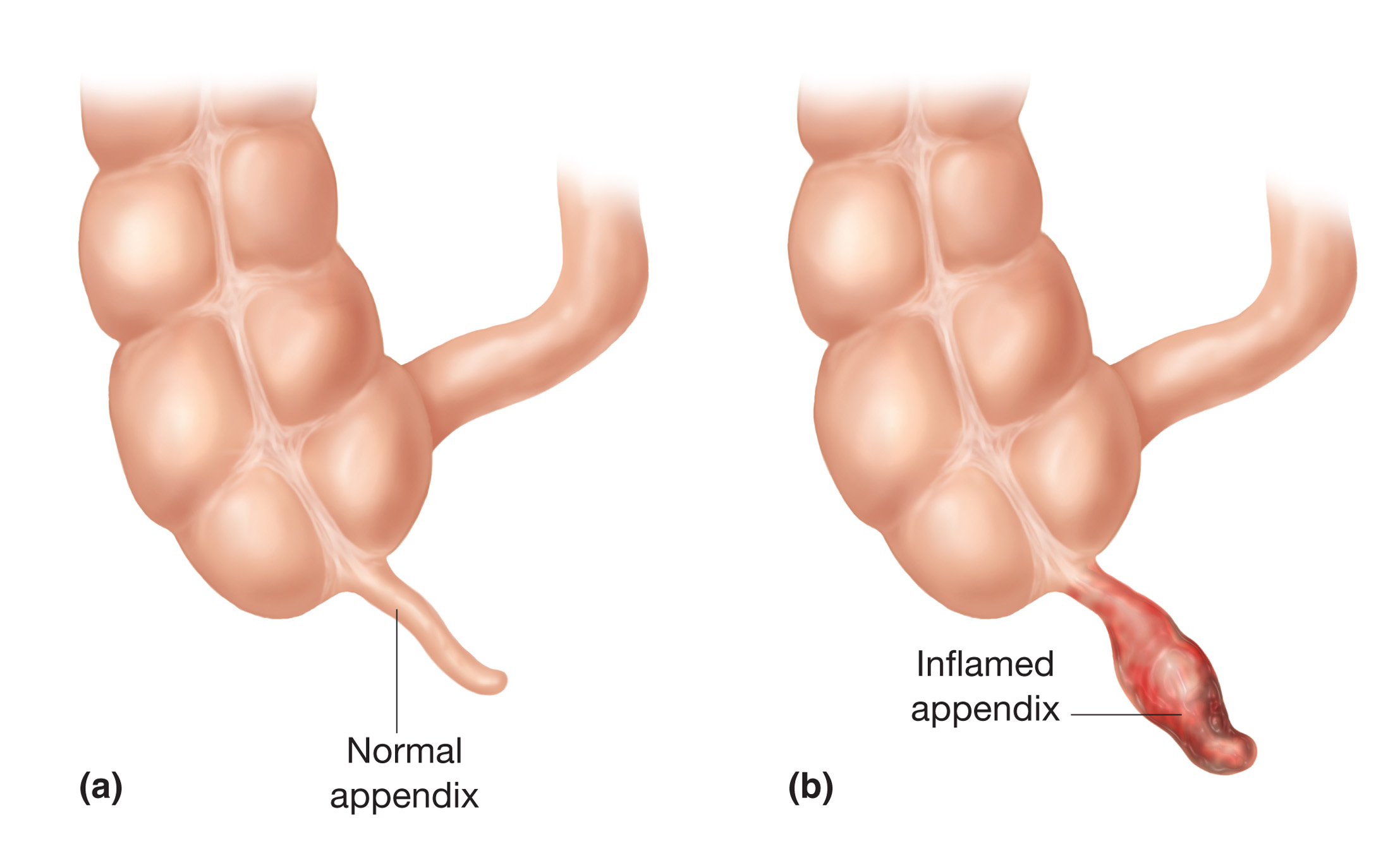 Appendicitis. (a) A normal appendix. (b) An inflamed appendix in appendicitis.  