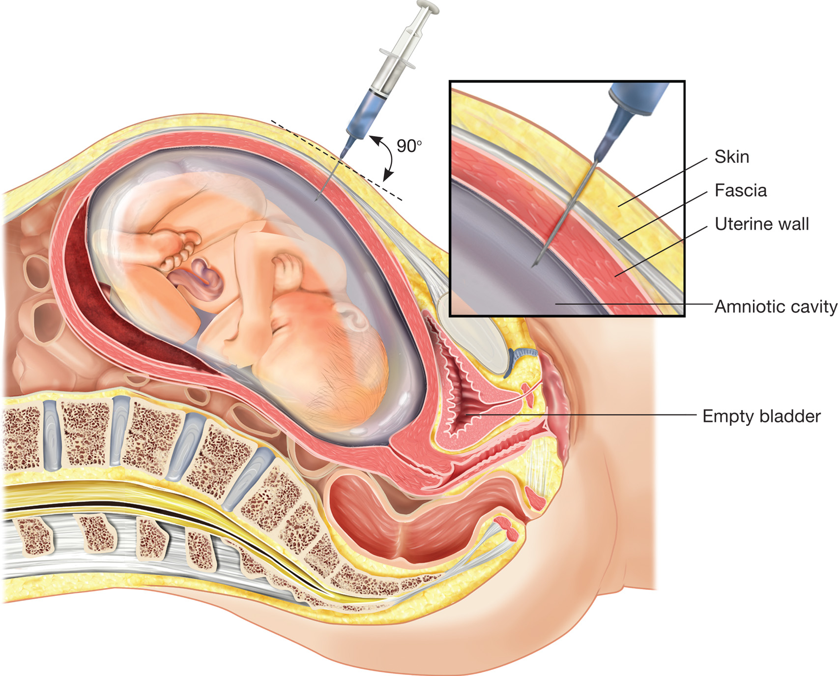 Amniocentesis. In this examination procedure, amniotic fluid is aspirated with a syringe that is ins