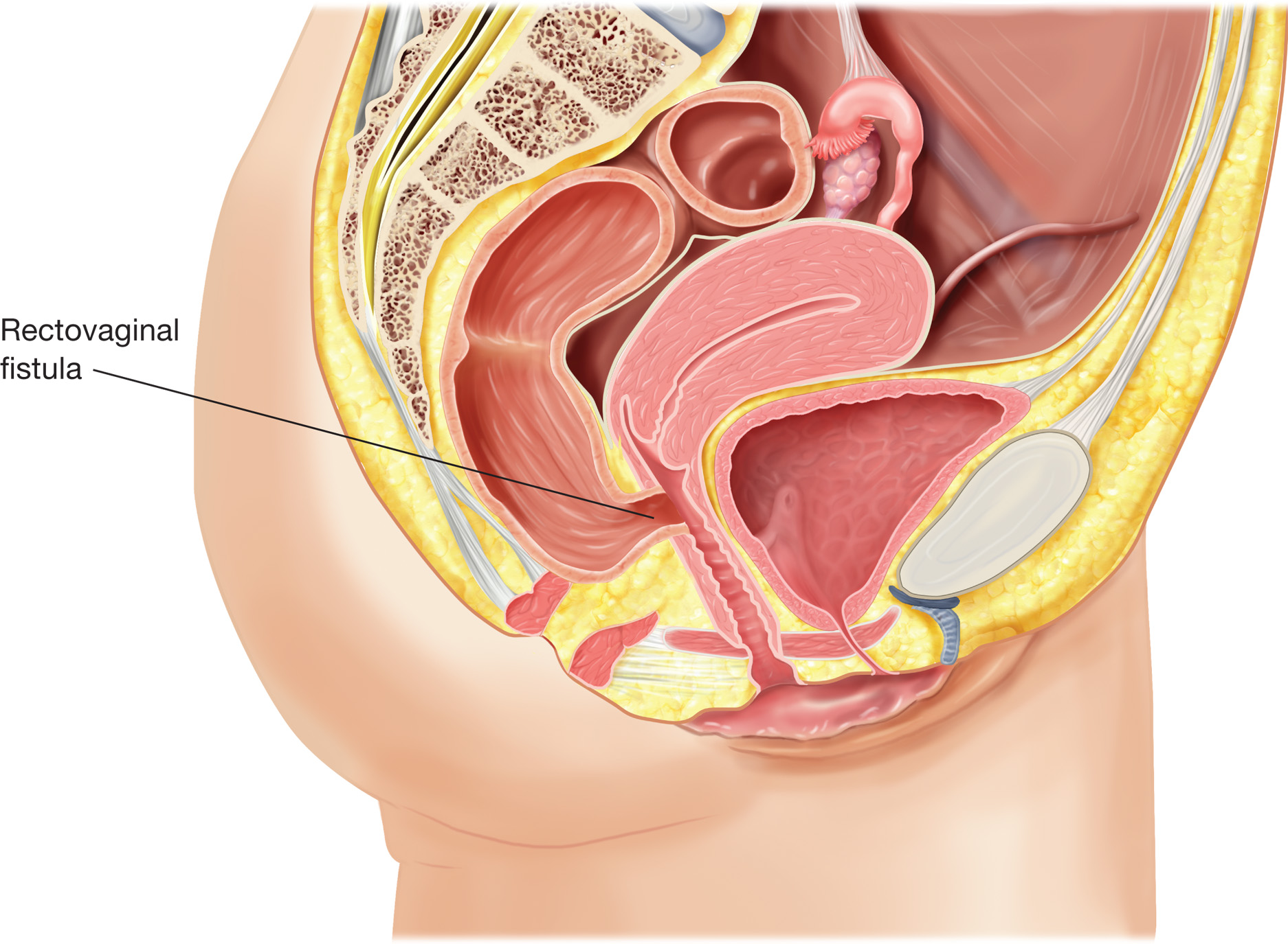 Rectovaginal fistula. It is an abnormal passageway between the rectum and vagina.