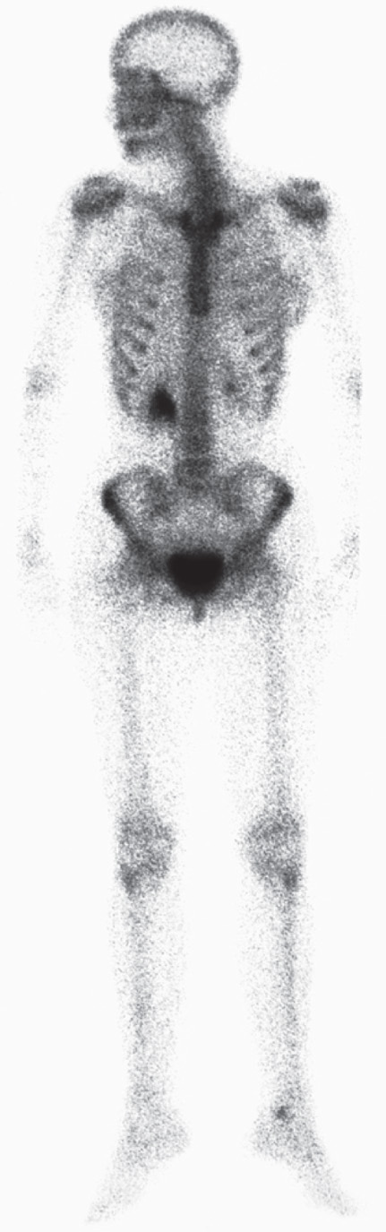 Bone Scans and Nuclear medicine