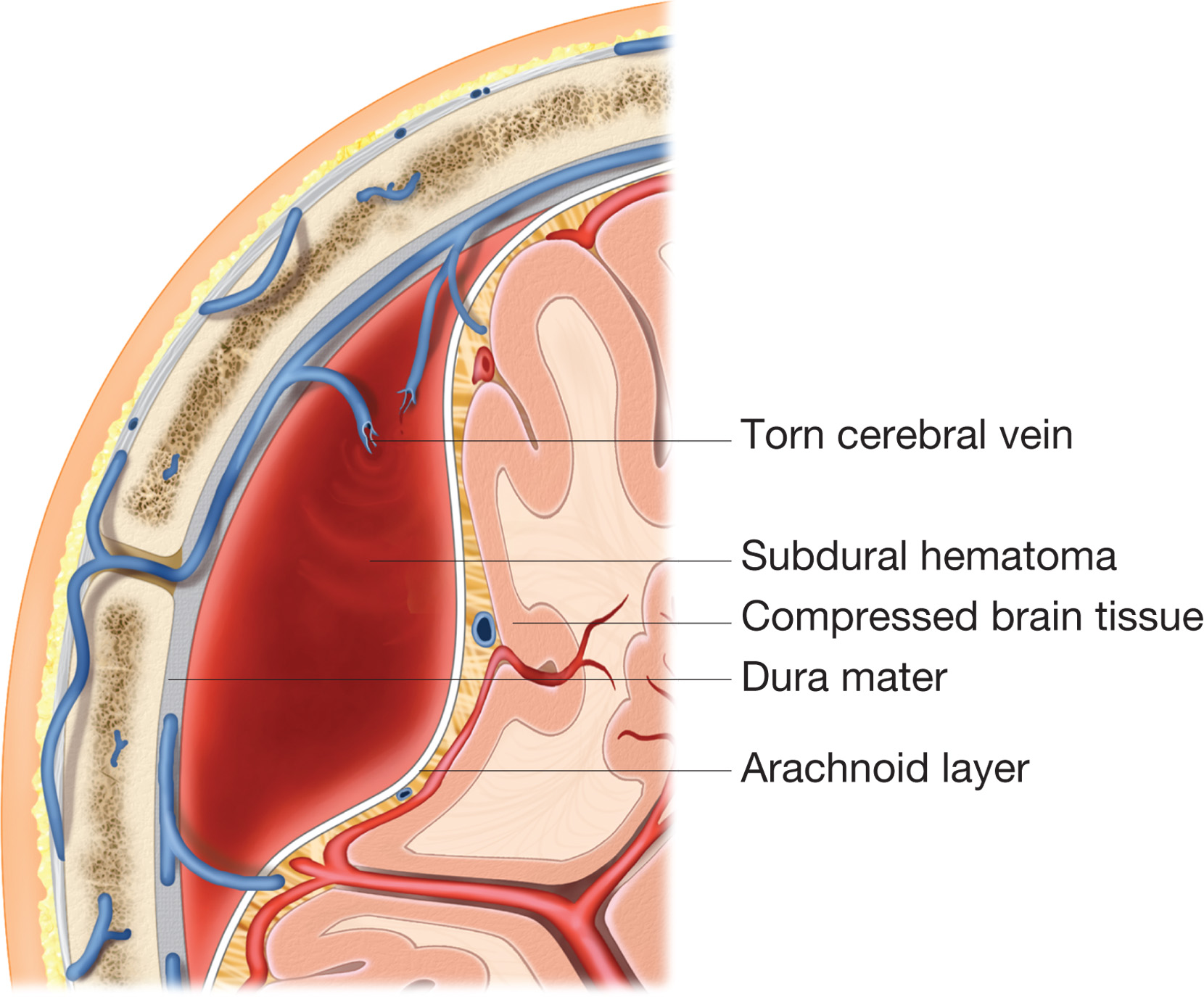 A subdural hematoma. A meningeal vein is ruptured and blood has accumulated in the subdural space, p