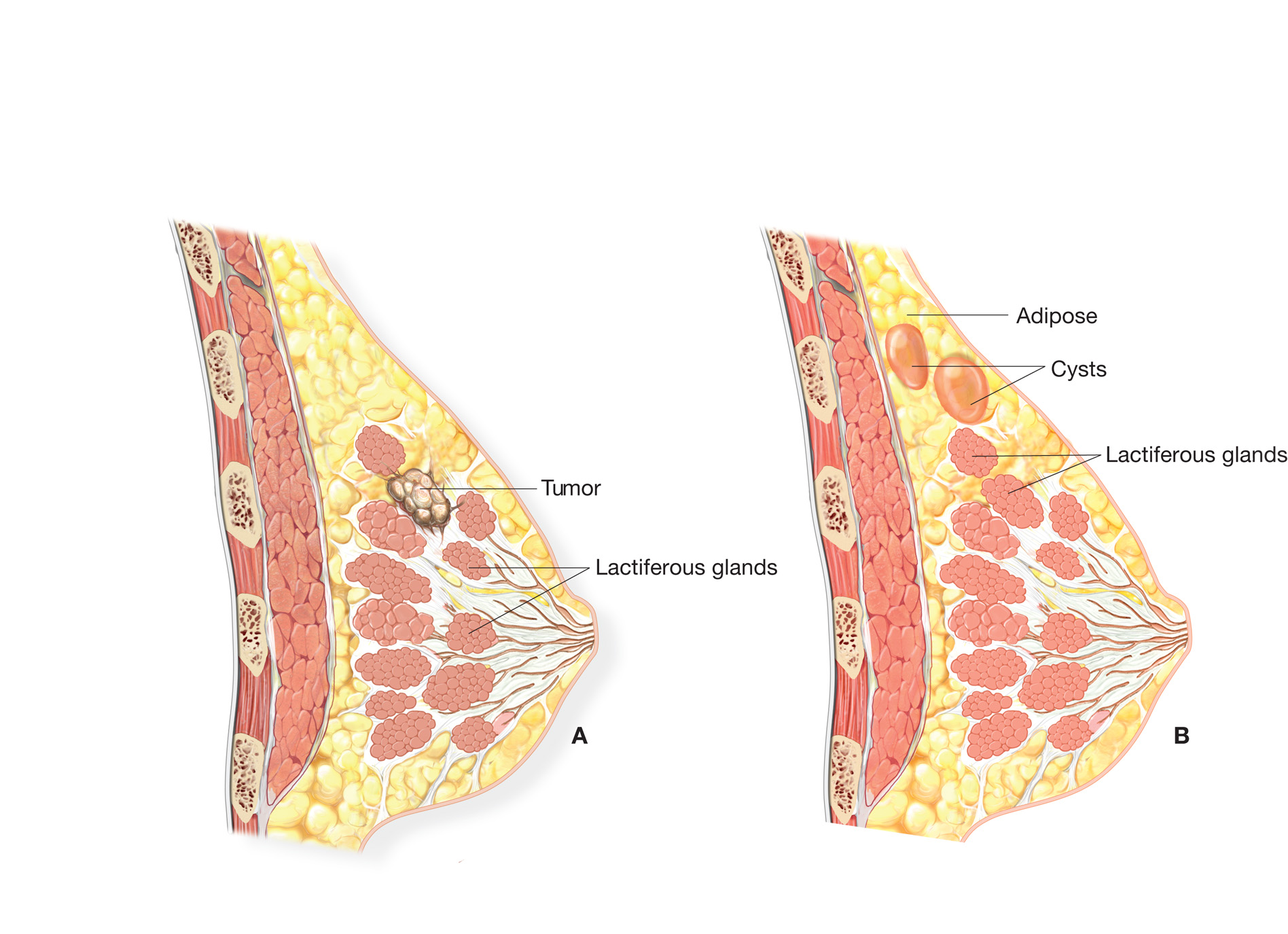 Comparison of breast cancer and fibrocystic disease. (A) Breast with a malignant tumor growing in th