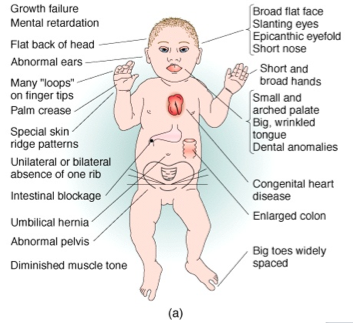 Down Syndrome