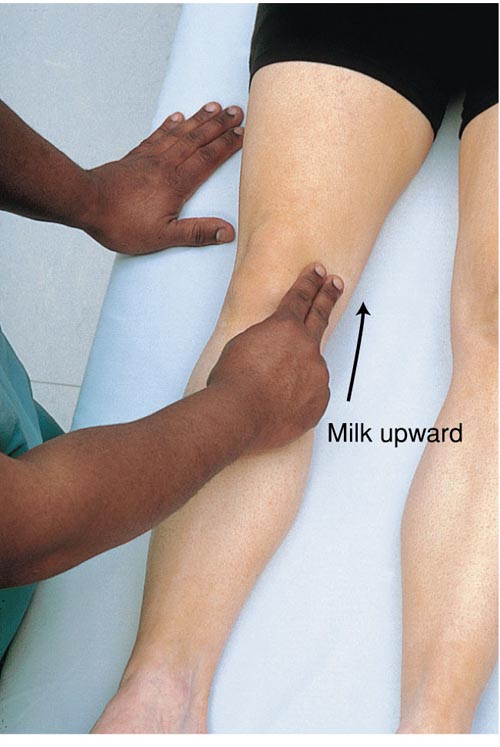 Assessing for Bulge Sign,  Milking the Patella