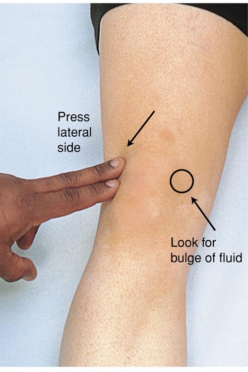 Assessing for Bulge Sign, Observing for Fluid