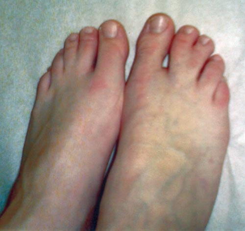 Toe Abnormalities: Syndactyly in the 2nd and 3rd Metatarsals of the Right Foot