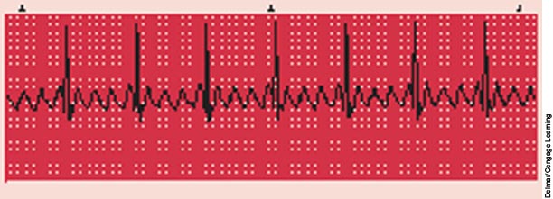 Atrial flutter.