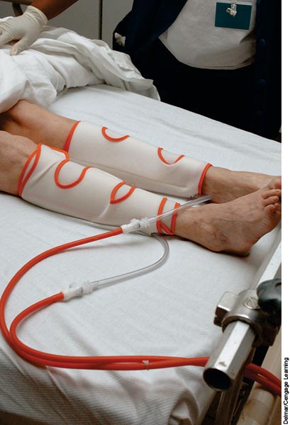 An alternating pneumatic compression device squeezes the leg tissues causing blood to move toward th