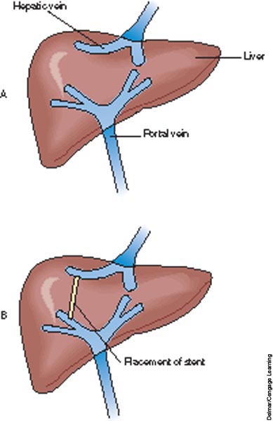 Blood flow before TIPS