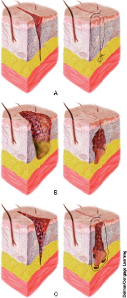 Wound healing