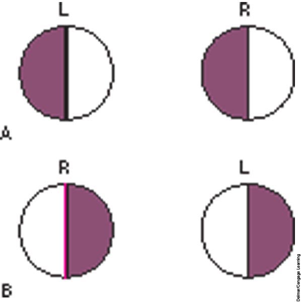 homonymous hemianopia