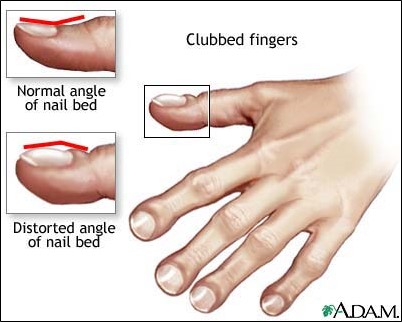 clubbing nail