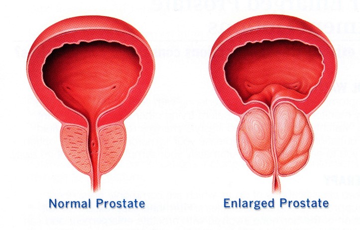 enlarged prostate