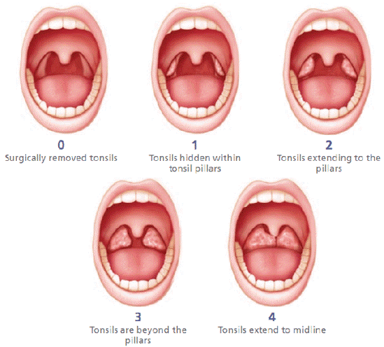 tonsils