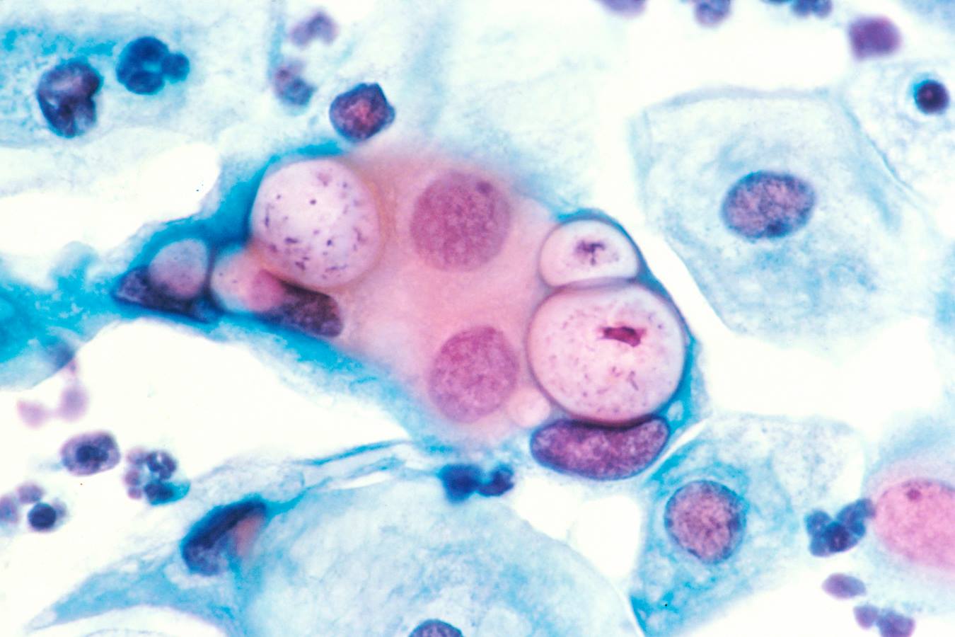 Chlamydia trachomatis