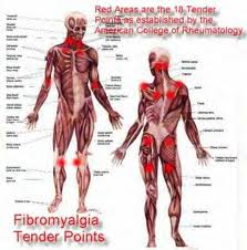 fibromyalgia