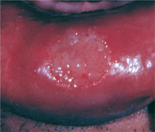 Lip Abnormalities, Chancre from Primary Syphilis