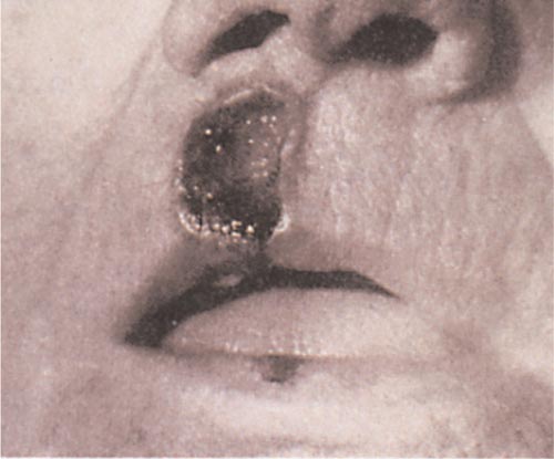 Lip Abnormalities, Basal Cell Carcinoma