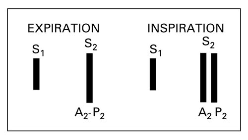 Summation of Heart Sounds, Normal Physiological Split of S2