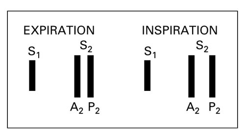 Summation of Heart Sounds, Wide Splitting of S2