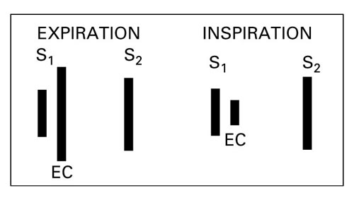 Summation of Heart Sounds, Pulmonic Ejection Click