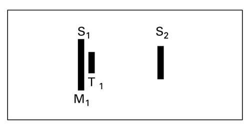 Summation of Heart Sounds, Wide Split of S1