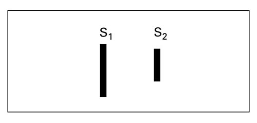 Summation of Heart Sounds, Soft S1