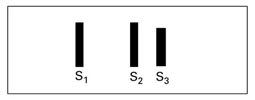 Summation of Heart Sounds, S3