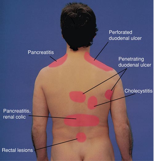 Areas of Referred Pain, Posterior View