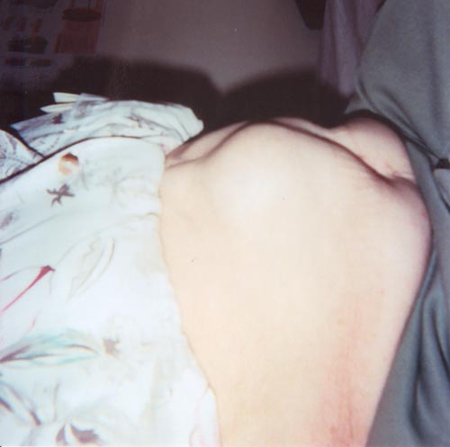 Umbilical Hernia