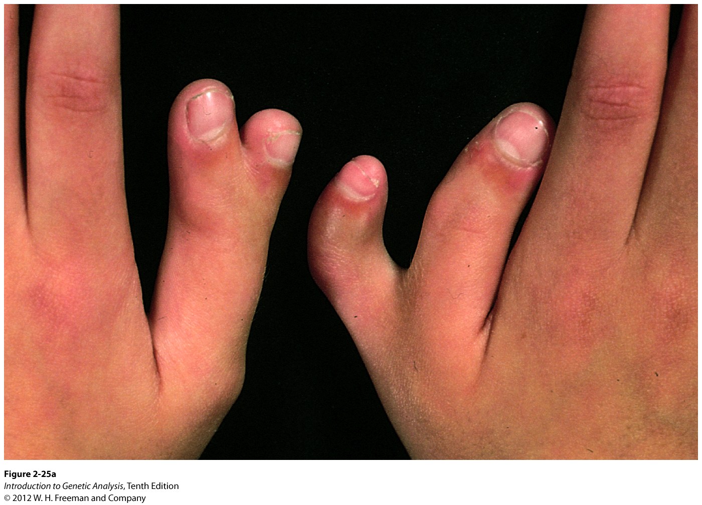 Polydactyly