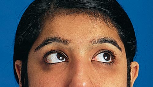 Assessing Palpebral Conjunctiva, Patient Position