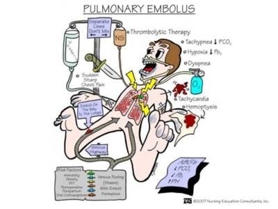 Pulmonary embolism