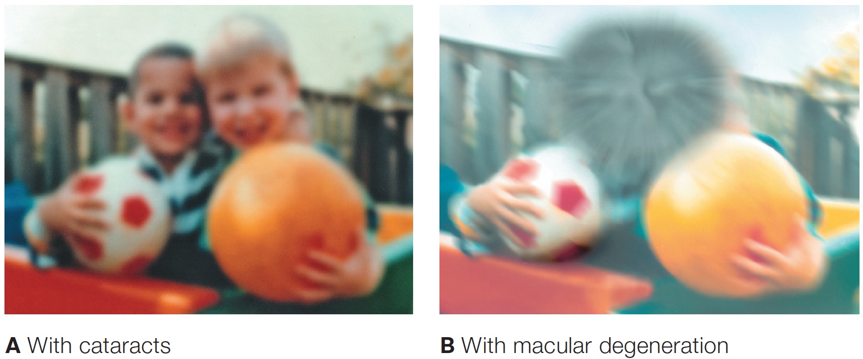 Photos simulating vision with two common visual disorders
